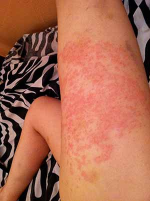 upper leg rash