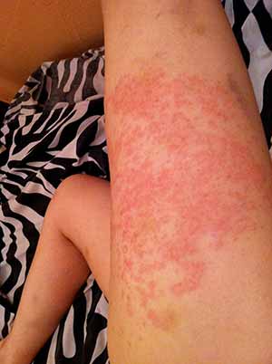 The Dh Rash - Dermatitis Herpetiformis - Celiac.com Celiac ...