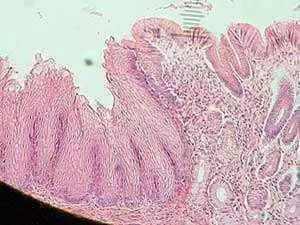 More information about "More Eosinophilic Esophagitis in Children and Adults With Celiac Disease"