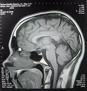 More information about "Brain Abnormalities in Patients with Celiac Disease and Neurological Issues"