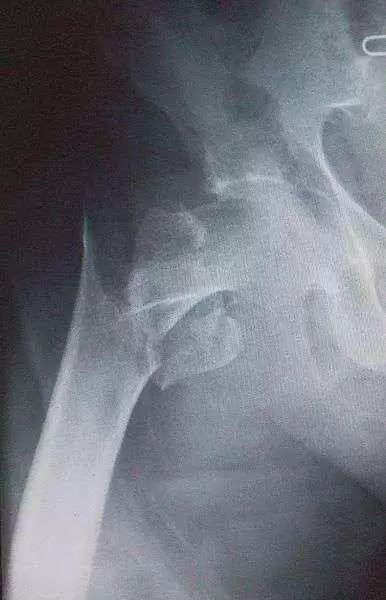 More information about "Higher Hip Fracture Risk in Celiac Patients with Villous Atrophy"