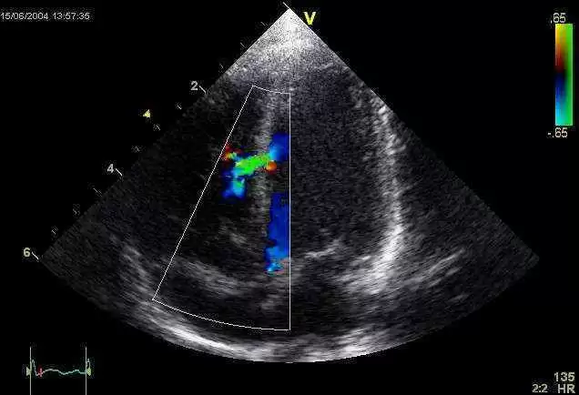 First Use of Echocardiography to Assess Left Ventricular Function in Celiac Patients - Image: Wikimedia Commons--Ekko