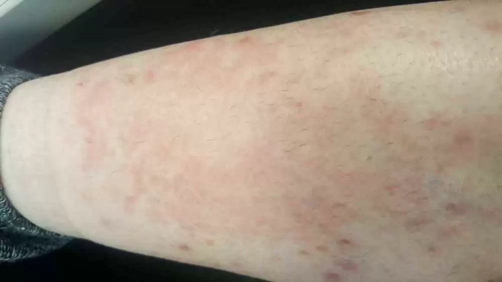 Rash.webp