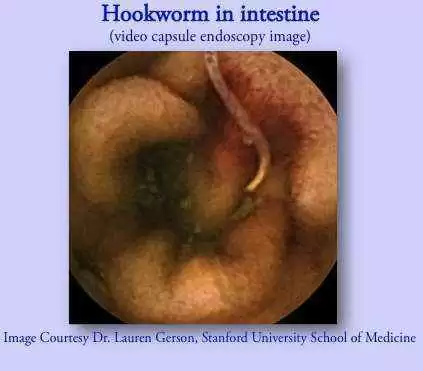 More information about "Have Celiac Disease? Try a Little Hookworm with that Pasta!"