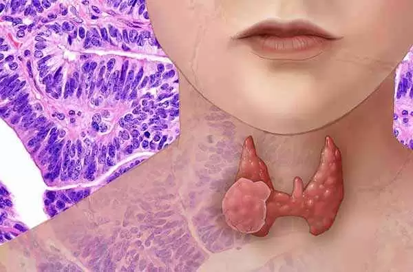 More information about "Thyroid Disease, Celiac Disease, and You"