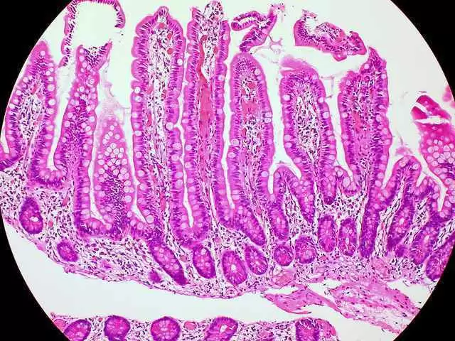 Did You Know? Musings on Irritable Bowel Syndrome, Dermatitis Herpetiformis and Celiac Disease