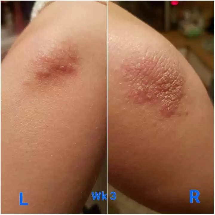 Look Like Dh Bilateral Itchy Bumpy Elbows Dermatitis Herpetiformis