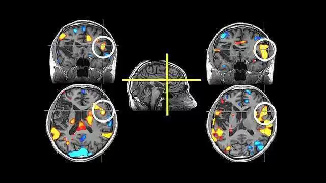 More information about "The MTHFR Mutation"