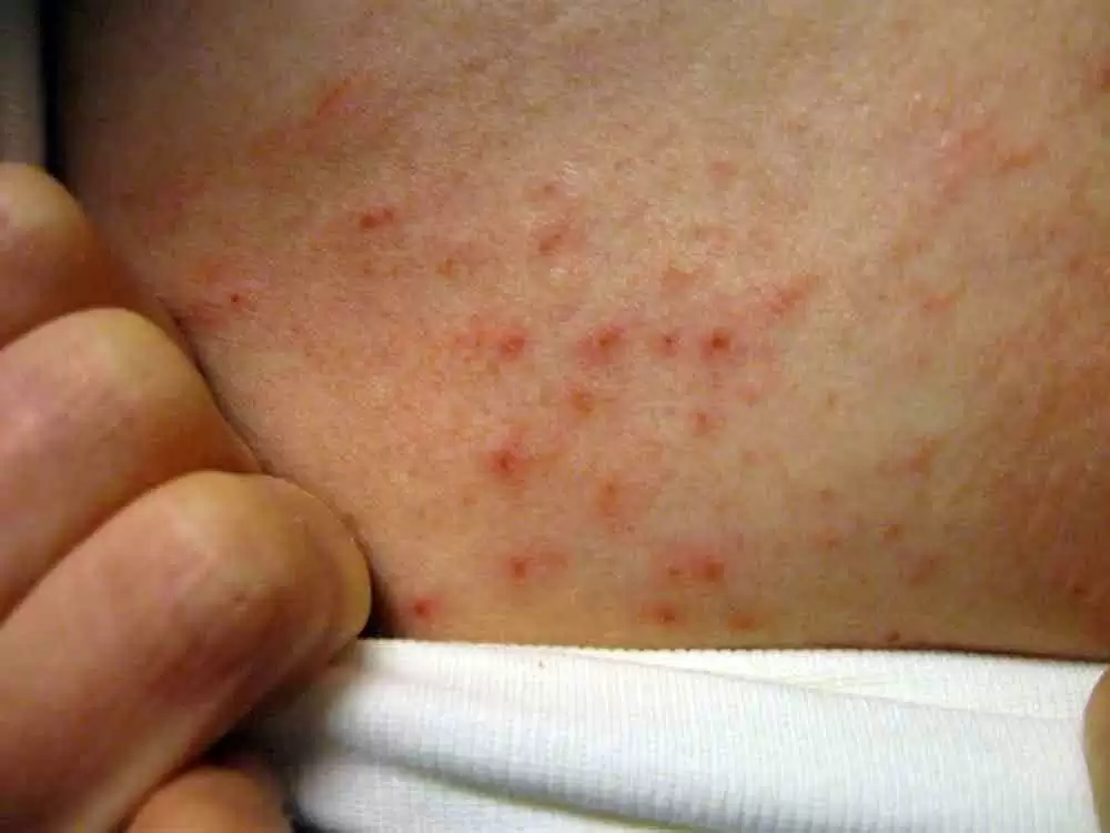 How Common is Dermatitis Herpetiformis in Celiac Disease Patients