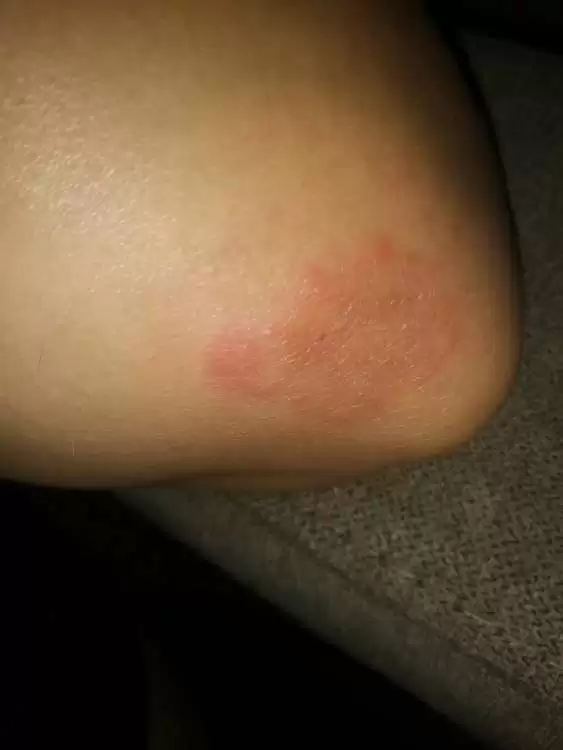 Rash On Elbow