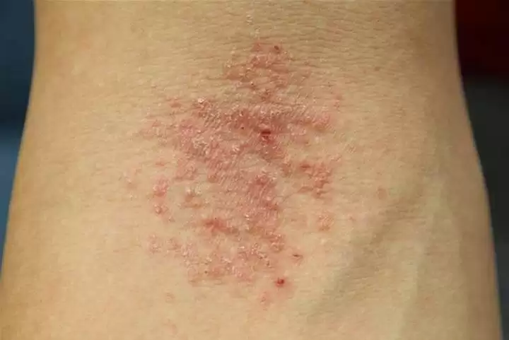 Very Itchy Rash Possible Dh