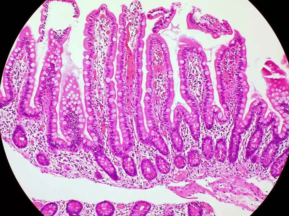 More information about "Can Diet and Mucosal Immune Response Drive Persistent Symptoms in Gluten-Free Celiac Patients?"