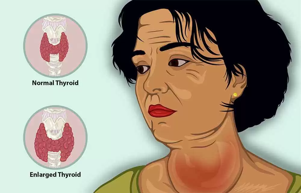 More information about "Gluten and Your Thyroid"