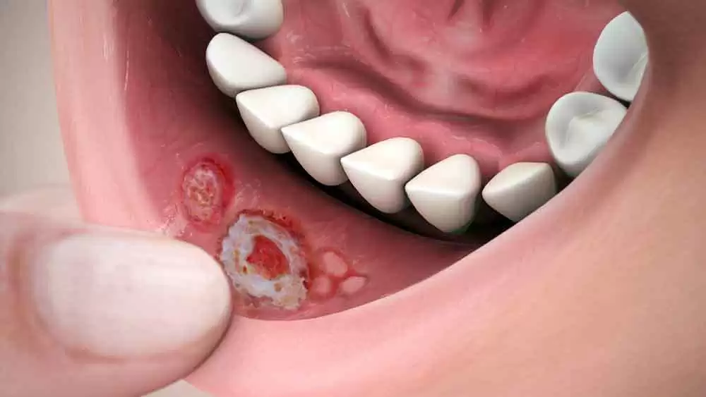 More information about "Recurrent Aphthous Stomatitis Points to Anemia and Celiac Disease"