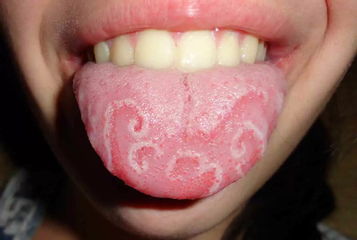 More information about "Geographic Tongue (Glossitis) and its Relationship with Celiac Disease"