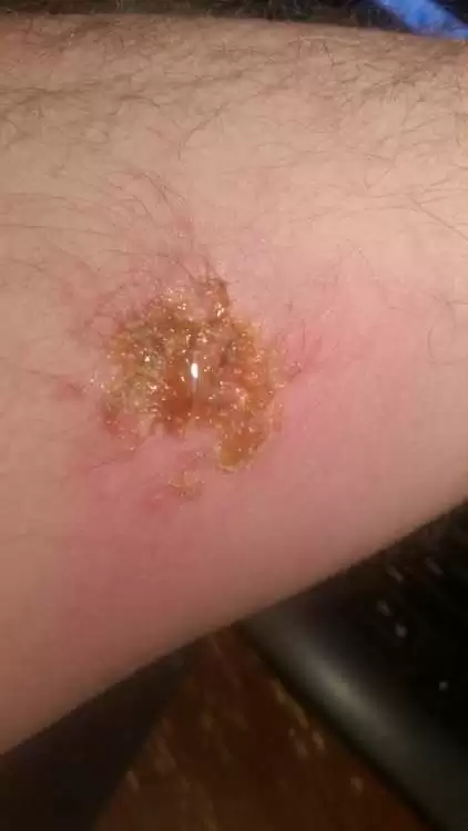 worm_wound4.webp.e8e15e3a7fb78acea8594f14dcca0fa2.webp