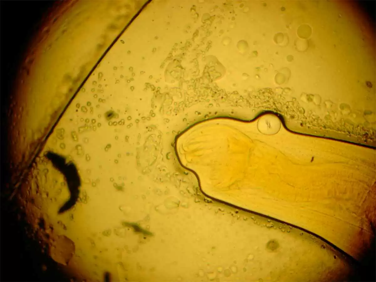 Man Claims Hookworm Treatment Led to Remission of Celiac Disease