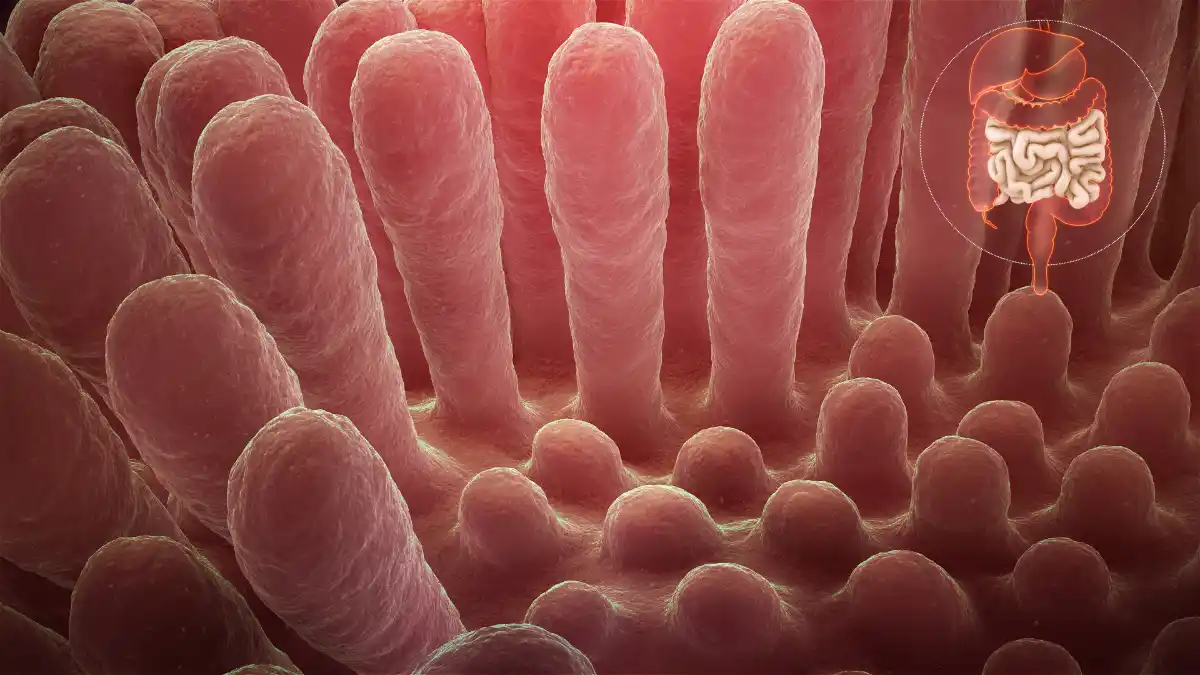 New Scoring System Identifies Celiac Disease Patients at Risk for Persistent Villous Atrophy - Inflammed mucous layer of the intestinal villi depicting Celiac disease. Image: CC BY-SA 4.0--www.scientificanimations.com