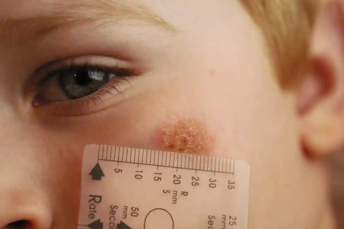 Researchers Hunt Connections Between Gluten Intolerance and Skin Disorders