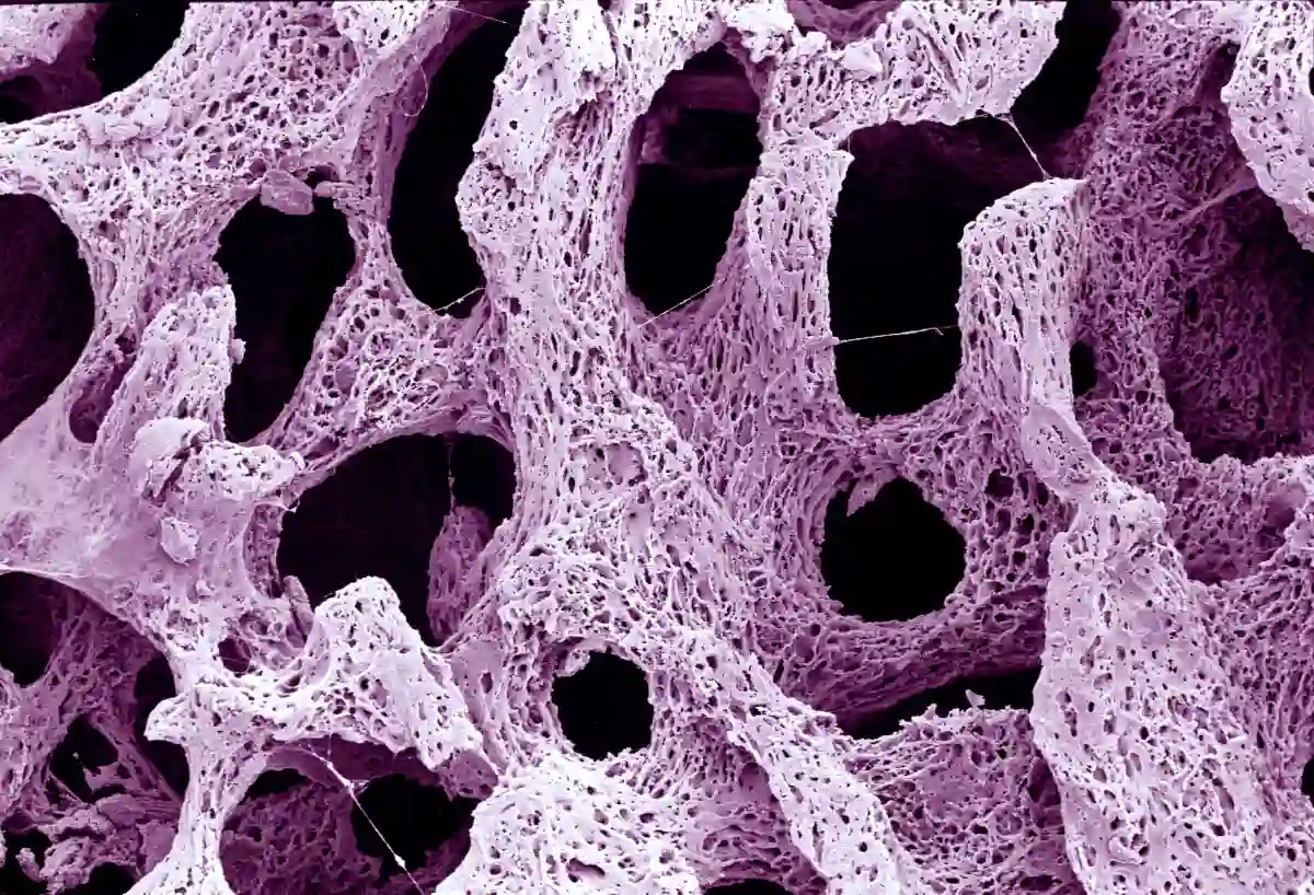 More Links Between Celiac Disease and Osteoporosis - SEM bone, rotten trabeculae (osteoporosis) is licensed under CC BY 4.0.