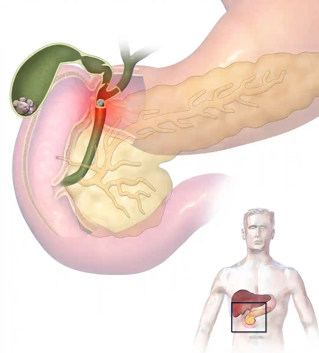 Researchers Explore Gallbladder Dysfunction in Celiac Disease - Gallstones and Ascending Cholangitis by BruceBlaus is licensed under CC BY-SA 4.0.