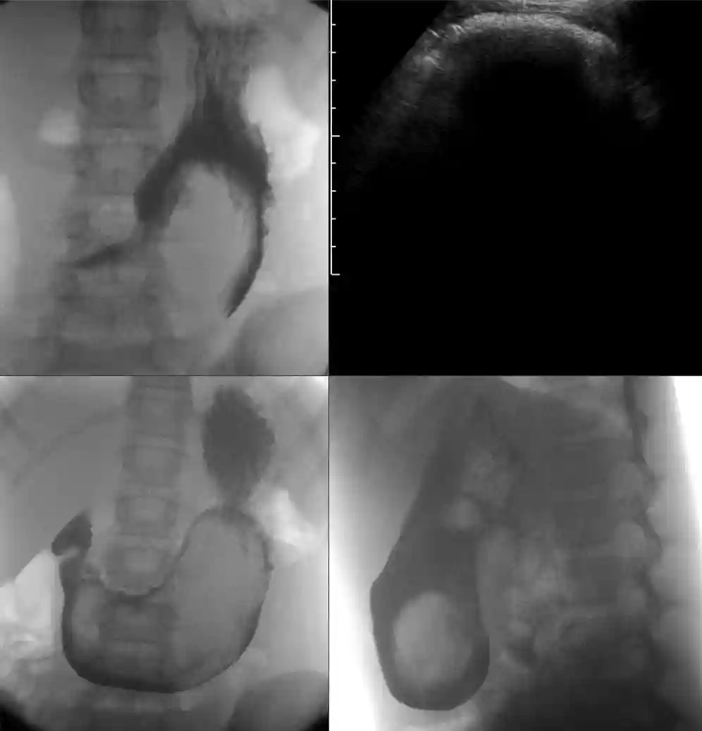 Trichobezoar Reveals Undiagnosed Celiac Disease in Young Woman: A Rare Case Study - Trichobezoar im Magen 11W - RF und US - 001 by Hellerhoff is licensed under CC BY-SA 4.0.