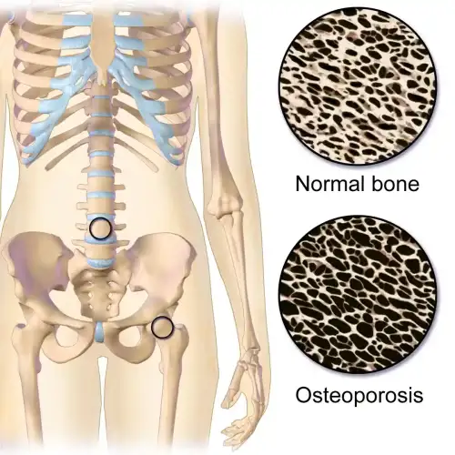 Optimizing Osteoporosis Screening in Celiac Disease - Osteoporosis Locations by BruceBlaus is licensed under CC BY-SA 4.0.