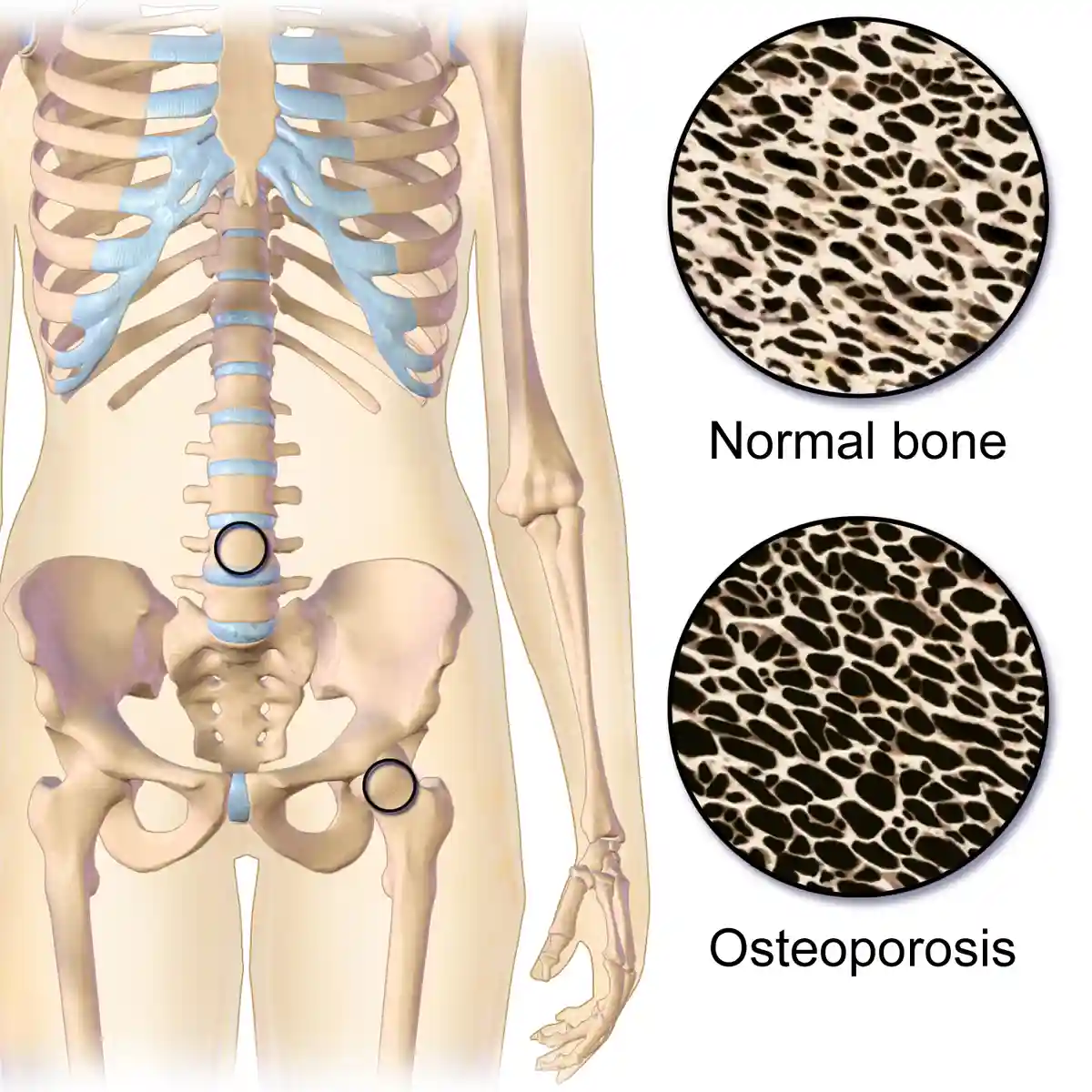 More information about "Optimizing Osteoporosis Screening in Celiac Disease"