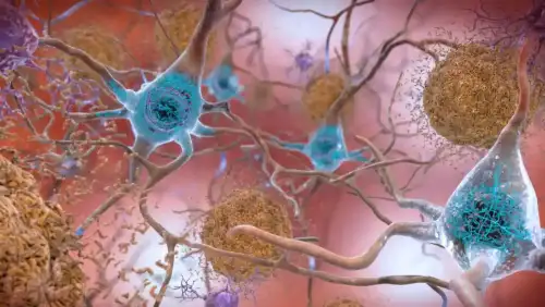Could Gluten and Alzheimer’s Be Linked? New Research Uncovers Surprising Protein Parallels (+Video) - Beta-Amyloid Plaques and Tau in the Brain by National Institutes of Health (NIH) is marked with Public Domain Mark 1.0.++ Watch the Video ++