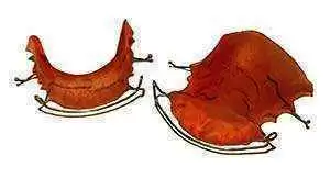 More information about "Can Gluten in Orthodontic Retainers Trigger Ongoing Celiac Symptoms?"